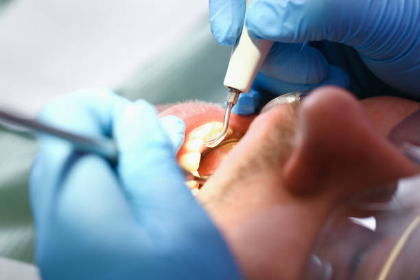 Best Emergency Wisdom Tooth Extraction in Ballville, OH