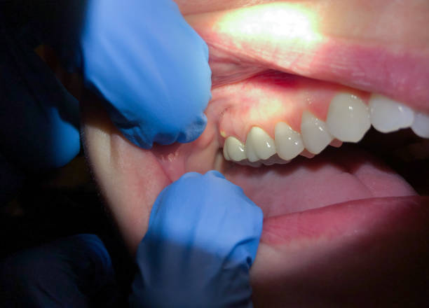 Best Lost Filling or Crown Replacement in Ballville, OH